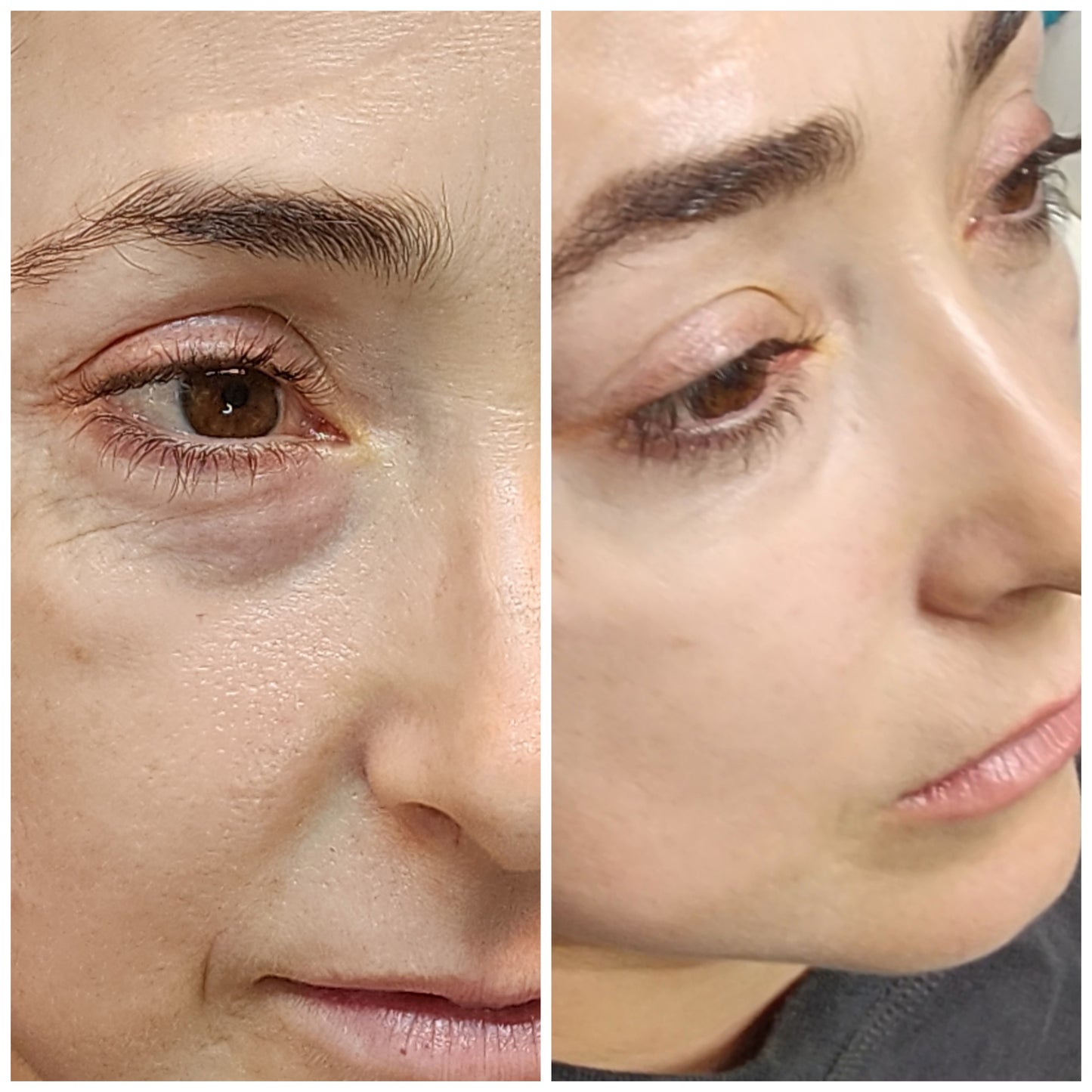 Blefaroplastia