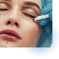 Blefaroplastia