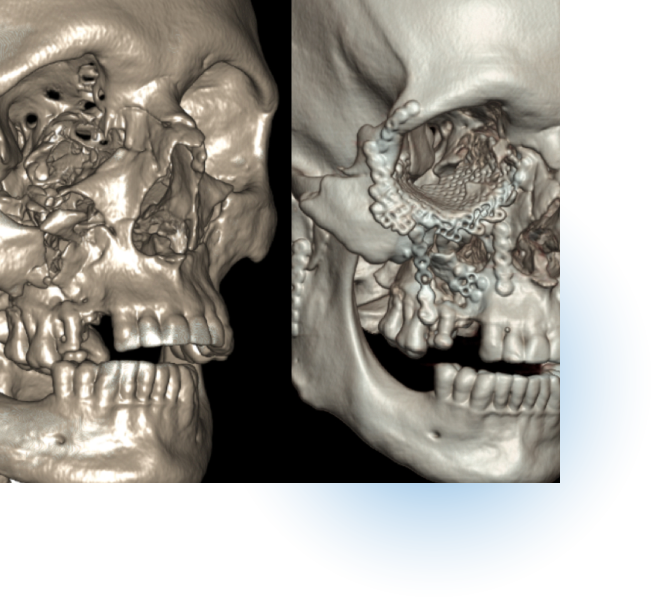 Trauma Facial